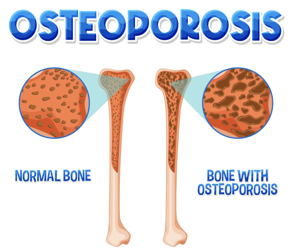 osteoporosis treatment in indore, best orthopedic doctor in indore