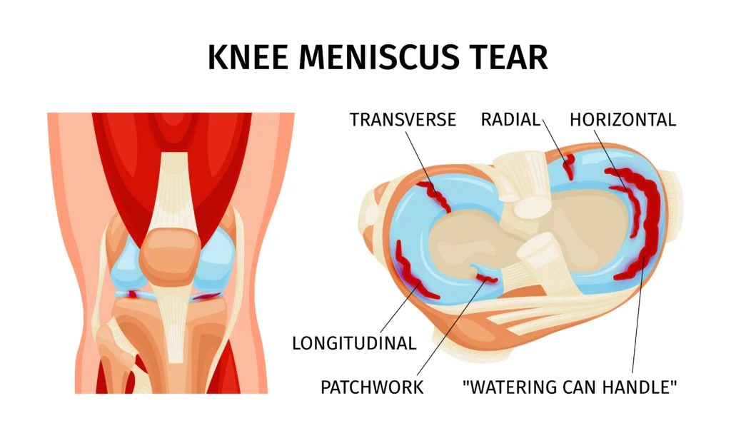 meniscus tears surgery in indore, best orthopedic doctor in indore